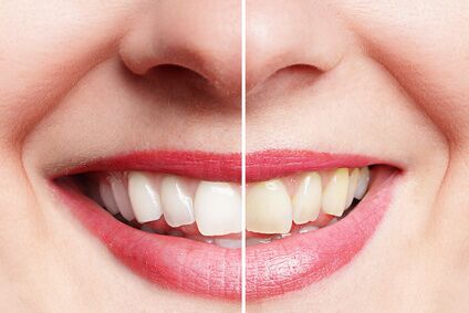 Vorher- / Nachher- Bleaching Vorher- / Nachher- Bleaching